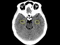 Checklist guide for NCCT of the brain in emergencies.