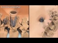 Scoliose opération ! Nouvelle technique 2017 Redresser la colonne vertébrale Scoliose opération ! Nouvelle technique 2017 Redresser la colonne vertébrale