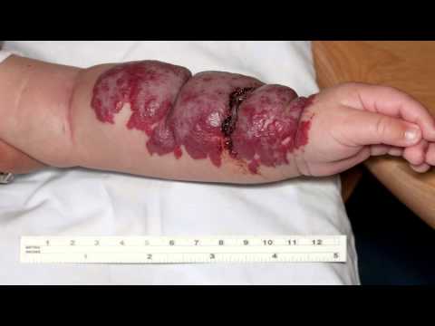 Video: Jak rozpoznat a přenášet jahody Birthmarks (Harmangiomas) - Baby zdraví A-Z