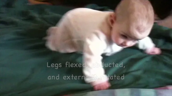 AIMS Evaluation 3 to 6 Months Education and Practice Case 14 Prone Lying