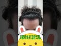 #드림헤어라인의원#압구정모발이식 #정수리모발이식 #헤어라인교정 #강남모발이식 #비절개모발이식 #절개모발이식 #생착률