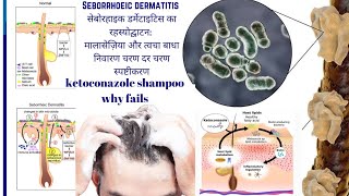 Seborrheic Dermatitis Demystified: Ketoconazole Malassezia & Skin Barrier | StepbyStep Explanation
