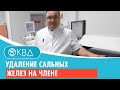 Удаление сальных желез на члене. Клинический случай №159