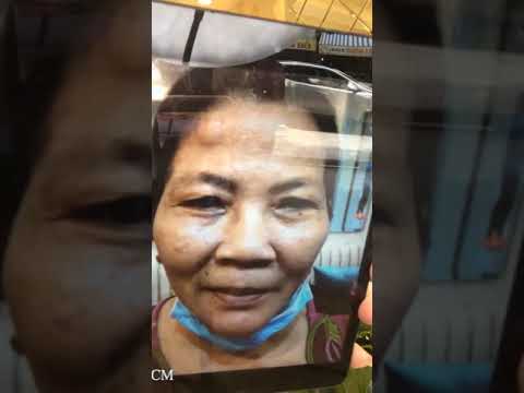tham my vien ngoc yen ca mau New Cắt treo vừa xong, Trẻ thêm 10 tuổi | Thẩm mỹ viện Song Ngọc