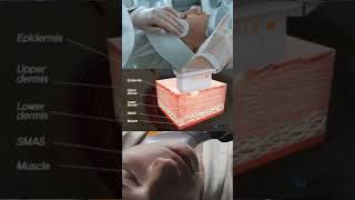 Эффект безоперационной подтяжки и омоложения кожи. Подробности по ссылке в профиле 💫