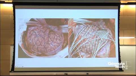 Epilepsy – Beyond the Local Network