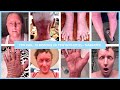 12 Months of Topical Steroid Withdrawal in Photos – Narrated