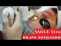 ReLEx SMILE Xtra (СМАЙЛ Экстра) - лазерная коррекция зрения СМАЙЛ и кросслинкинг - видео операции