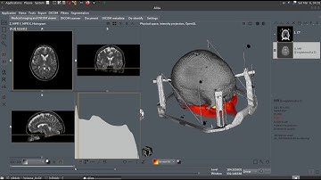 Aliza DICOM Viewer. Image Registration. Visualize registered images.