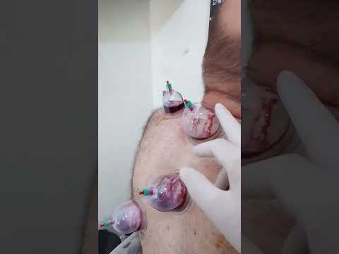 قلم الحجامة الخاص بمرضى السكري