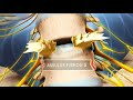 Herniated disc medical animation  ghost productions
