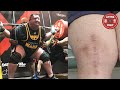 This Man Squatted 525 kg After A Full Knee Replacement