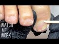 Gentle dry pedicure technique, thick stubborn cuticle | Watch Me Work