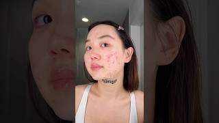 Thumbnail of Change takes time ❤️‍🩹 #acne #clearskin