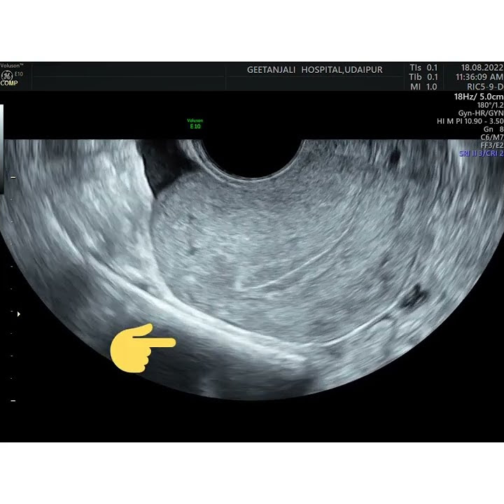 sliding sign, endometriosis, pelvic adhesions, Dynamic ultrasound
