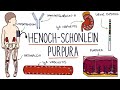 Henoch-Schonlein Purpura: Visual Explanation for Students