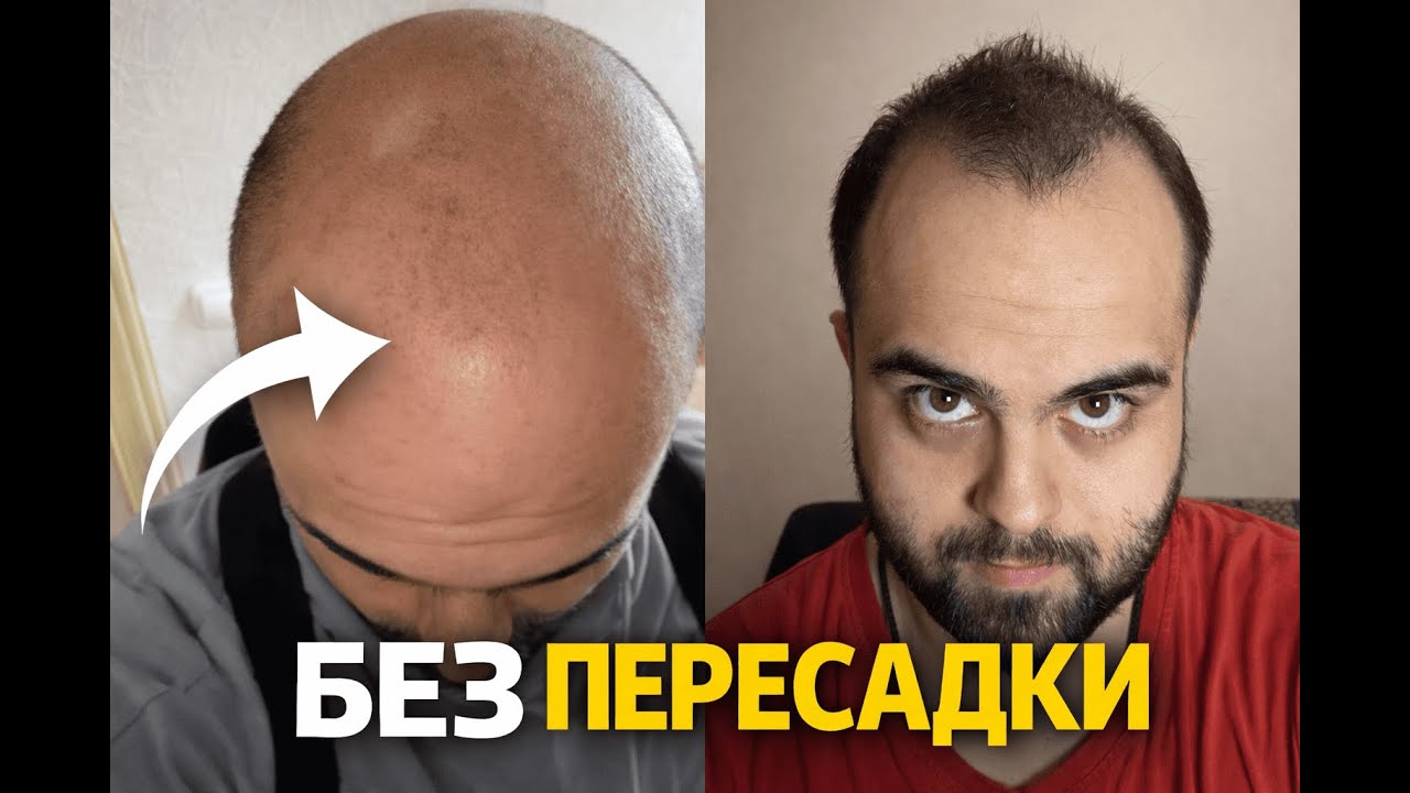 Как я вернул волосы без пересадки и победил облысение