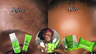 DONT USE TEA TREE PRODUCTS IF YOU HAVEN’T DONE THIS FIRST