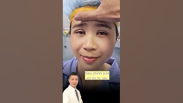 Rất nhiều người cắt mí bị như bạn | Dr Hùng Thanh