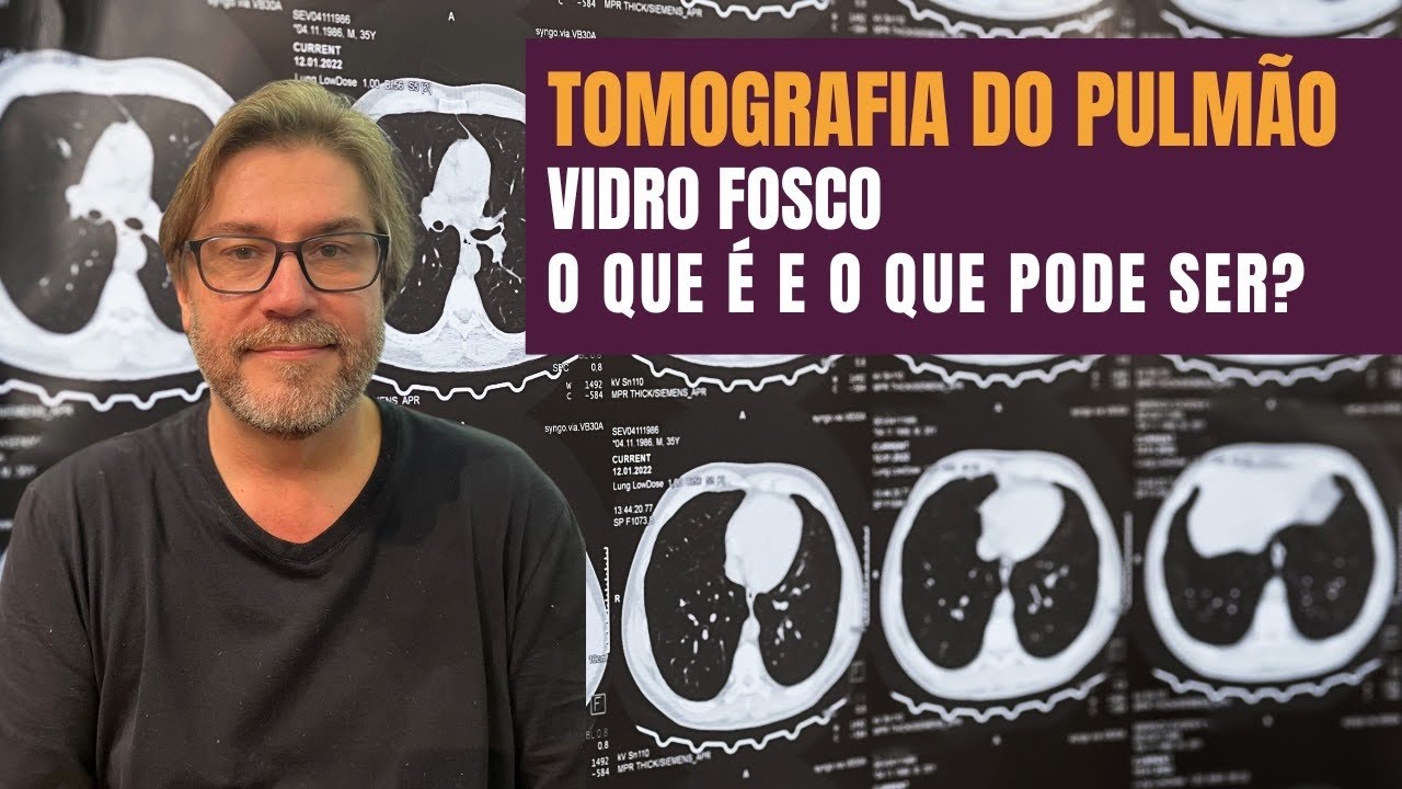 Opacidade em vidro fosco na tomografia do pulmão: o que é e principais ...