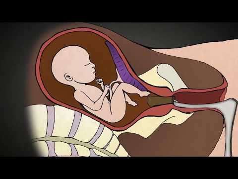 Video: Možete li umrijeti tokom abortusa?