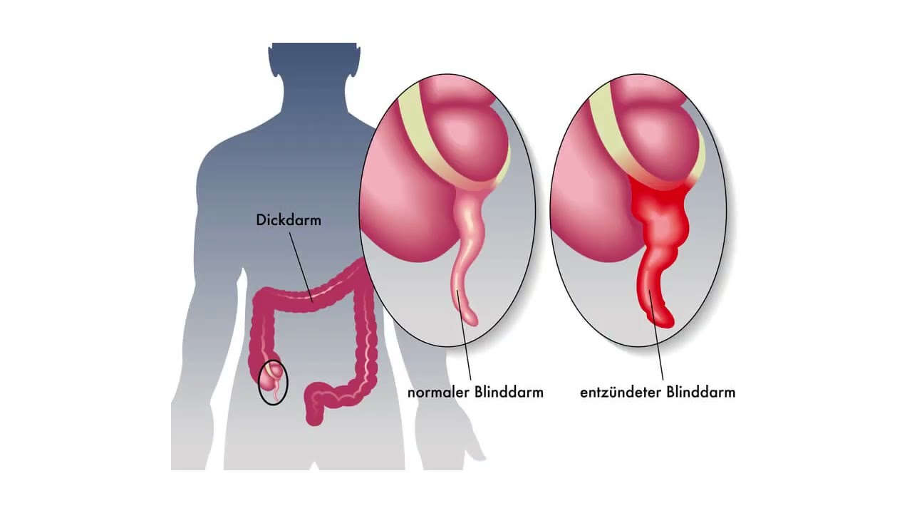 Remedios para el colon inflamado