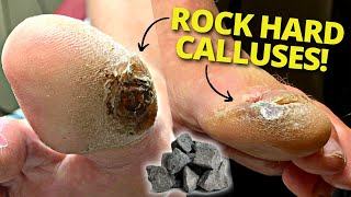 Cutting Down Blood Blistered DIFFICULT Calluses! (SO SATISFYING)