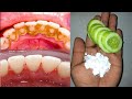 In just Two Minutes, teeth whitening at home with baking soda and Shine Your Teeth Like Pearls