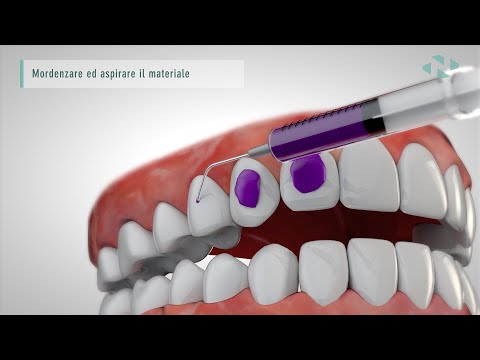 Video: Allineamento Dei Denti: Posizionamento Delle Parentesi Graffe