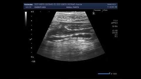 Inflamed Appendix with inflammatory fluid in the adjacent area.
