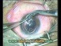Combined Penterating Keratoplasty ,cataract extr, and IOL implantation
