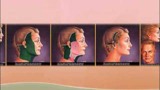 Face Lift Surgery New Jersey NJ