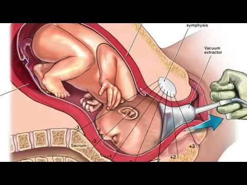 Что находится внутри вакуума Can Forceps Or Vacuum Extraction Devices Cause Injuries? - YouTube