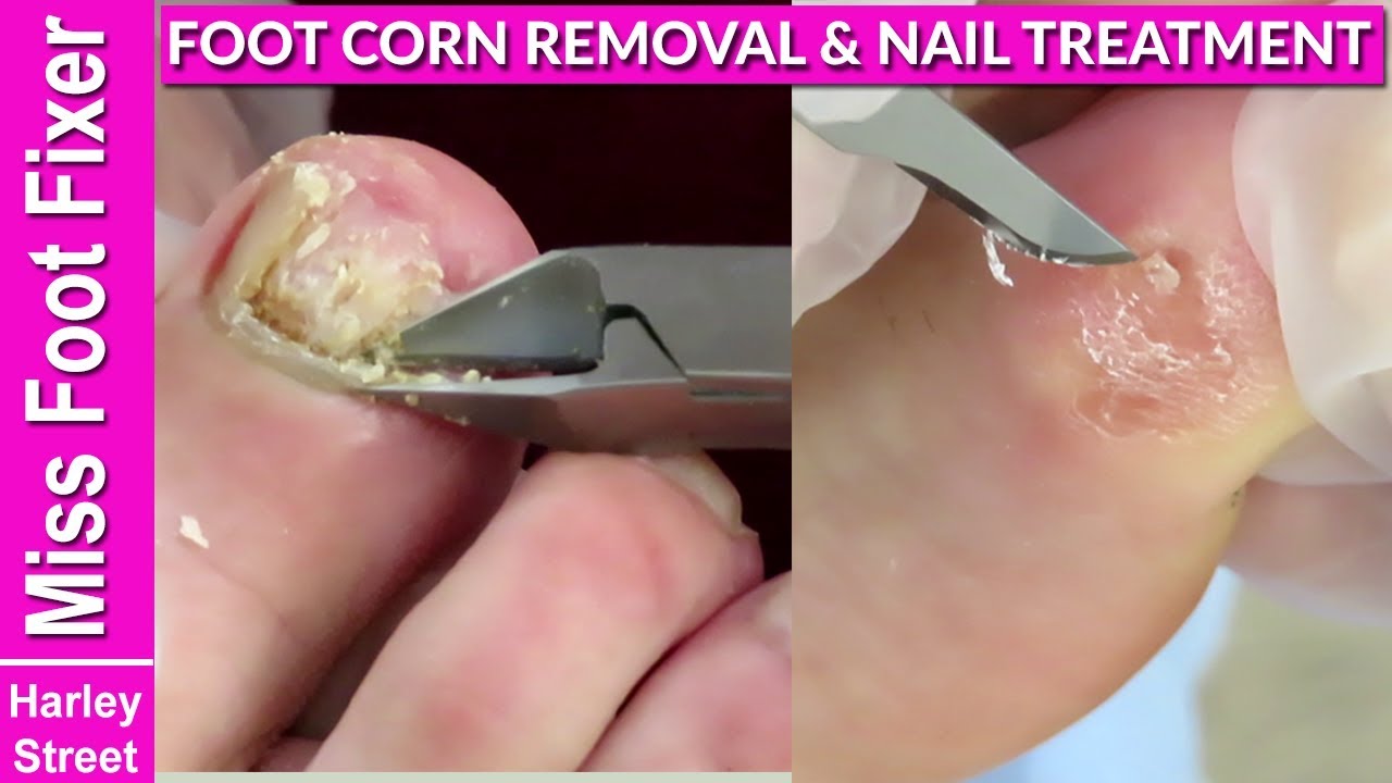foot corn removal