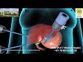 Cholecystectomy Gallbladder Removal (Hindi) - CIMS Hospital