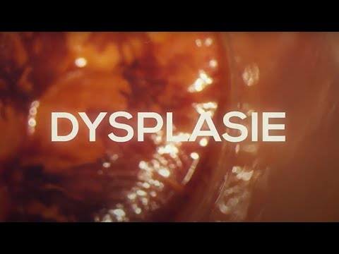 Vidéo: Quel spécialiste traite la dysplasie fibromusculaire ?