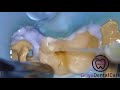 Class I Composite Procedure Replacing Amalgam