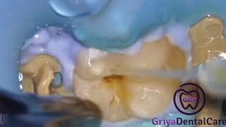 Class I Composite Procedure Replacing Amalgam