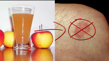 Wie oft Apfelessig bei Hautpilz?