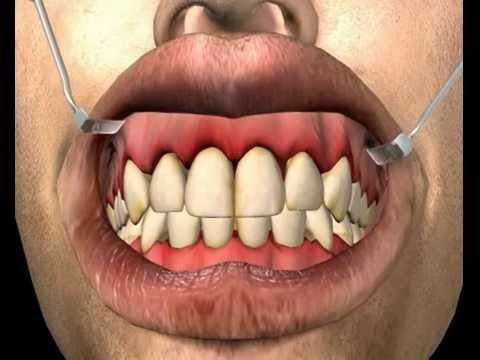 Video: 10 Rawatan Rumah Gingivitis: Apa Yang Berfungsi?