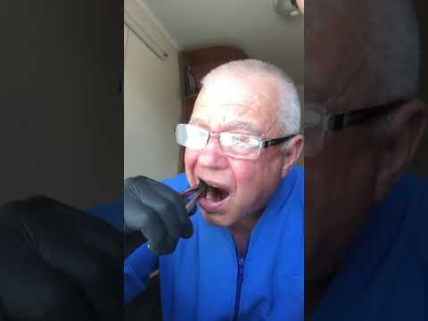 Удаление зуба самому себе Tooth extraction