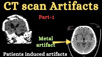 Part-1| CT scan artifacts |patient induced artifacts| CT artifacts in hindi