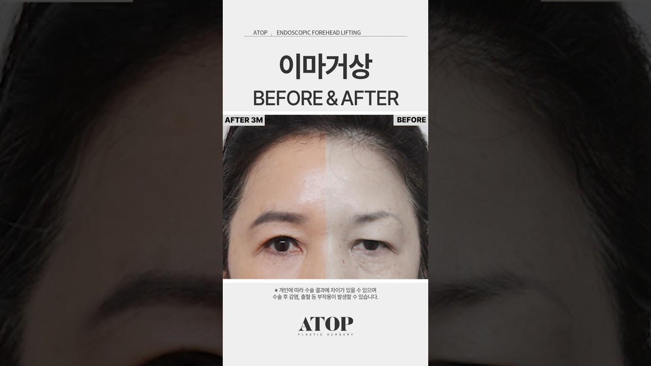 [Bệnh viện thẩm mỹ A-TOP] Nâng trán_Đánh giá 1