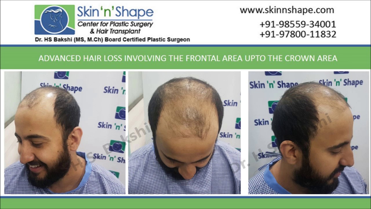 Cost Of Hair Transplant In Chandigarh Punjab India Skin N