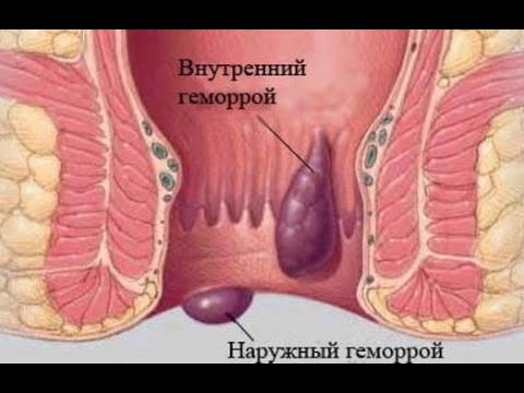 Видео: ★★ Как вылечить геморрой. Лечение геморроя лазером и в домашних условиях. Советы по проктологии