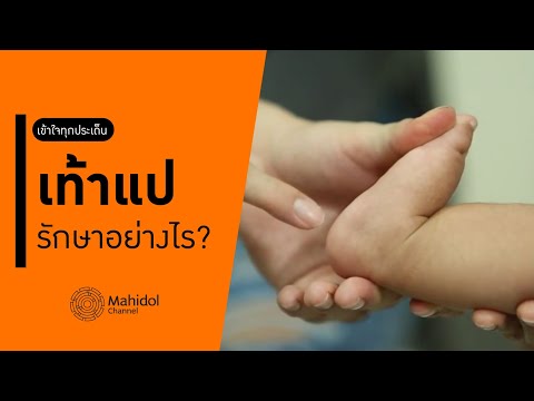 "เท้าแป" ในเด็ก รักษาอย่างไร? [หาหมอ by Mahidol Channel]