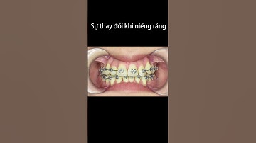 Sự thay đổi trước và sau 2 năm niềng răng khấp khểnh