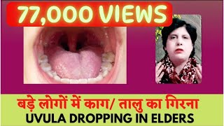 UVULA DROPPING IN ELDER