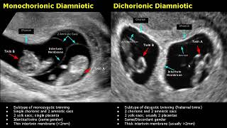 Fetal Twins Ultrasound Normal Vs Abnormal | Monochorionic\/Dichorionic\/Diamniotic\/Monoamniotic USG