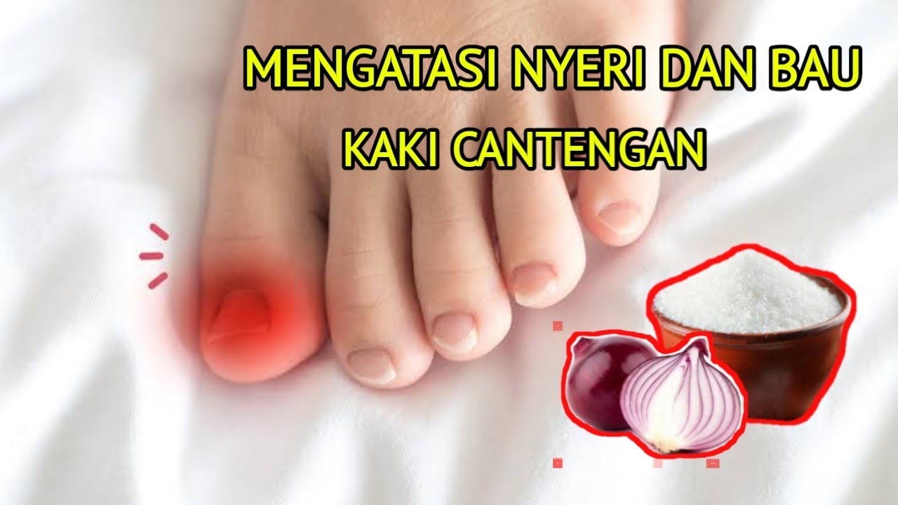 Cara Mengatasi NYERI dan BAU Kaki Cantengan dengan Resep sederhana 100